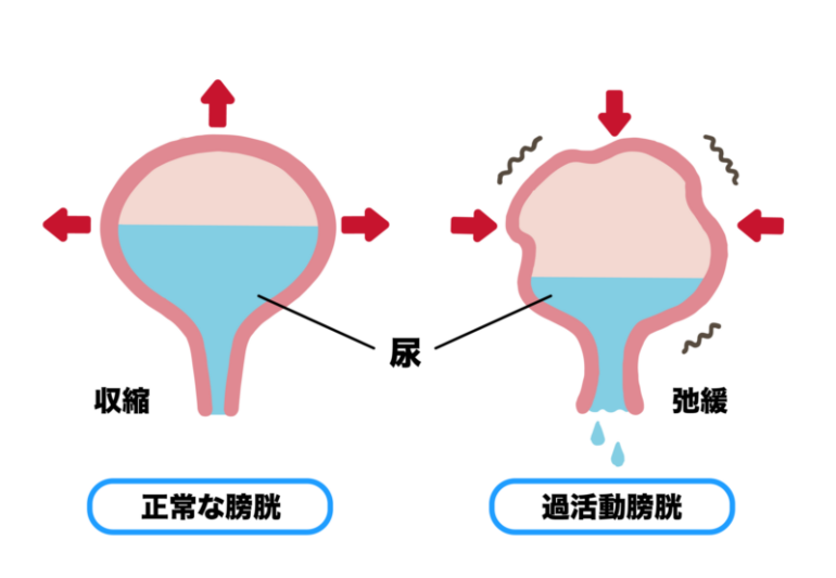 過活動膀胱
