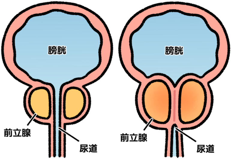 前立腺肥大